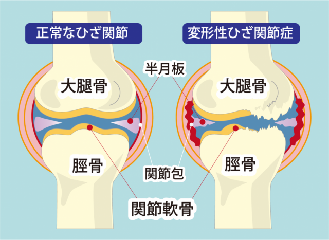 膝関節症